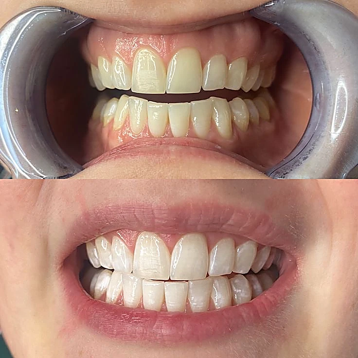 Antes y después de un blanqueamiento: arriba la sonrisa con el tono original, abajo los dientes más claros