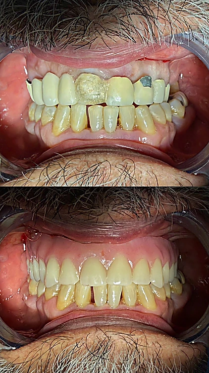 Antes y después de una rehabilitación: arriba dientes desgastados y rotos, abajo la sonrisa restaurada con coronas