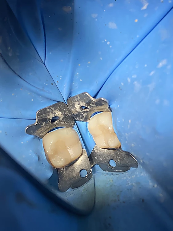 Dos coronas dentales con estructura metálica sobre el dique de goma azul