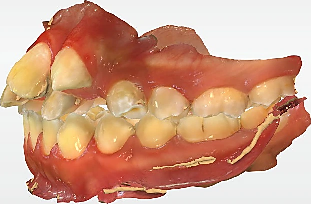 Escaneo digital 3D de una dentadura vista de lado